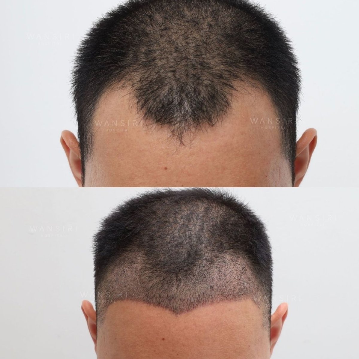 Before and after PRP hair loss treatment results at Wansiri Hospital, improved hair density