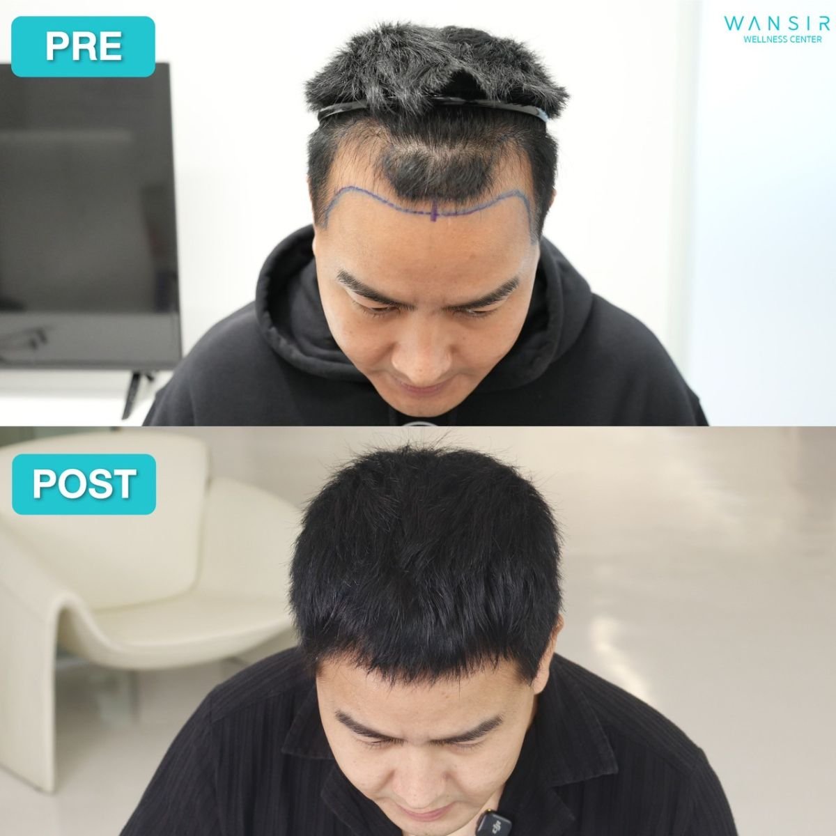 Before and after PRP hair loss treatment results at Wansiri Hospital, improved hair density