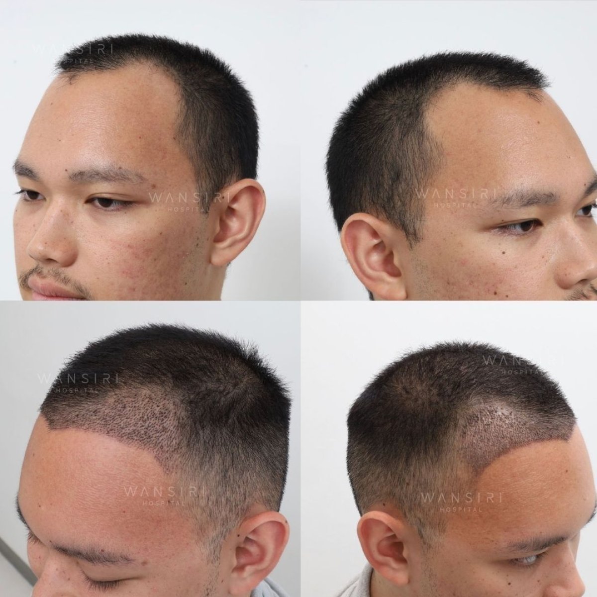 Before and after PRP hair loss treatment results at Wansiri Hospital, improved hair density