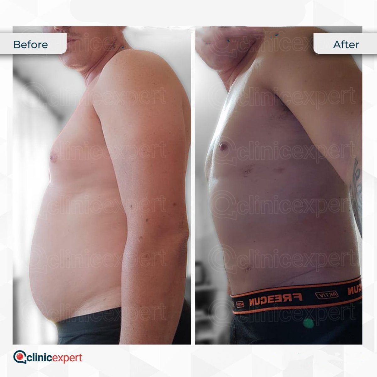 360 liposuction before and after results at CE International Hospital, improved body contour