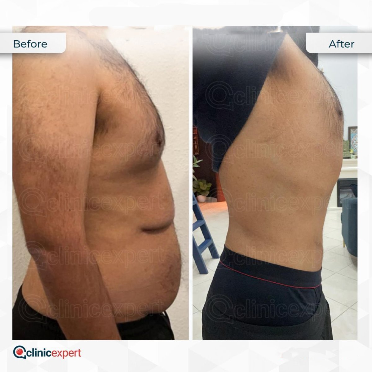 Before and after 360 liposuction results at CE International Hospital, improved body contour