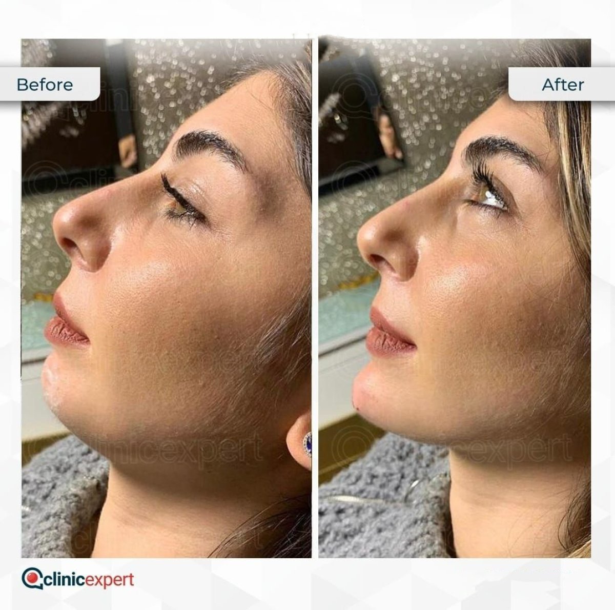 Before and after neck lift results at CE International Hospital, visible jawline and neck contour