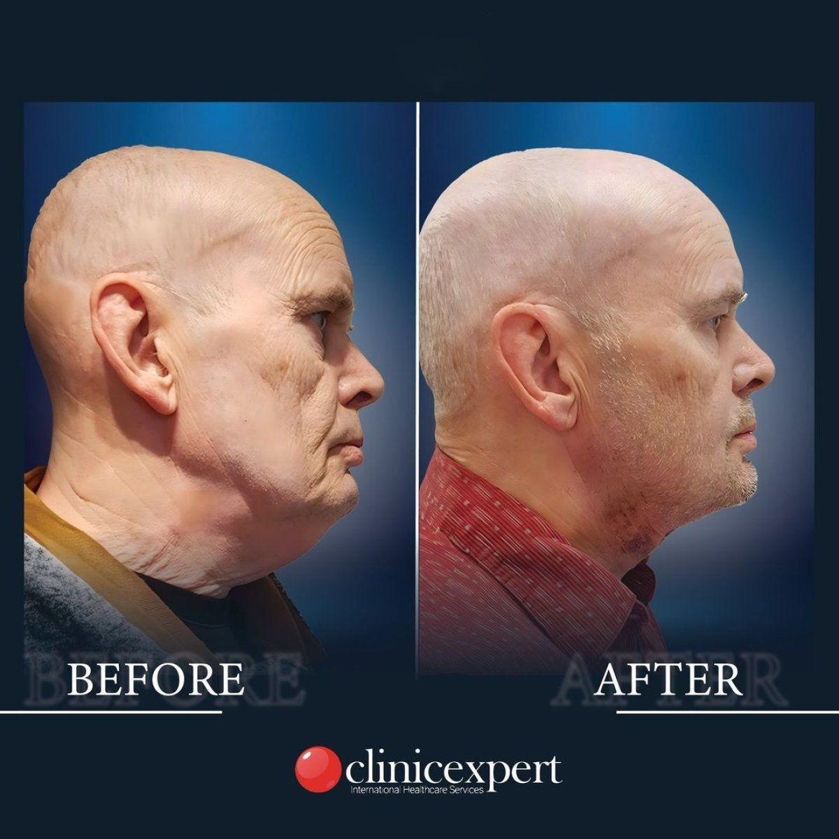Результаты до и после подтяжки шеи в CE International Hospital, улучшение контура шеи