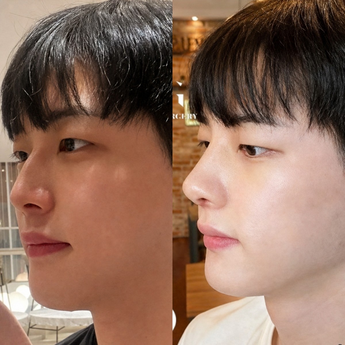 Resultados de rinoplastia antes y después en VG Plastic Surgery, mejor forma y perfil nasal