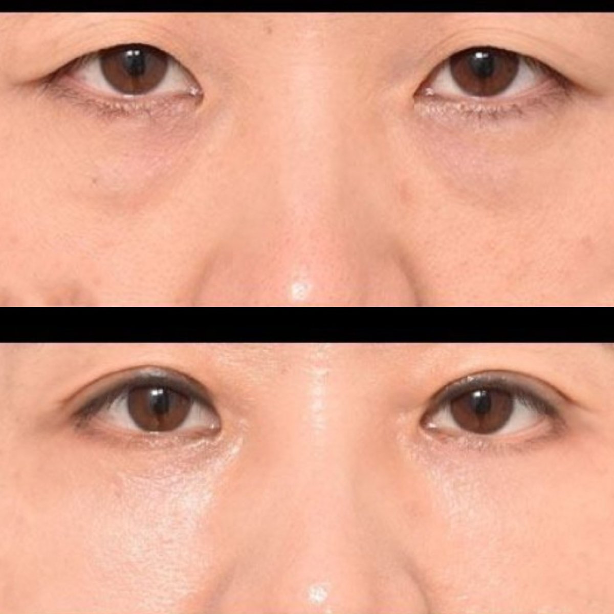 Resultados de blefaroplastia de párpado inferior antes y después en VG Plastic Surgery