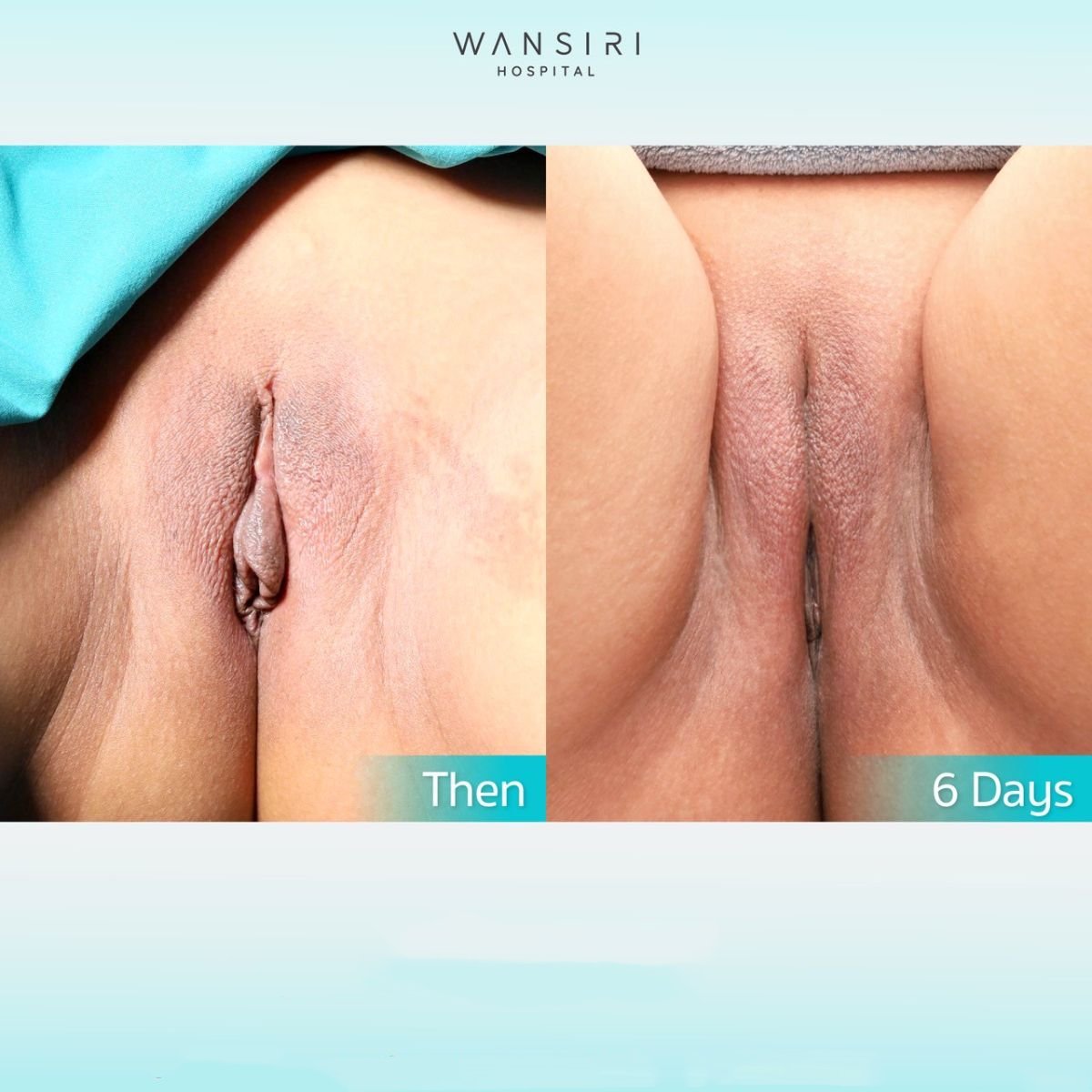 Лабиясы бар клиторлардың фотосуреттері Лабиясы бар клиторлардың фотосуреттері