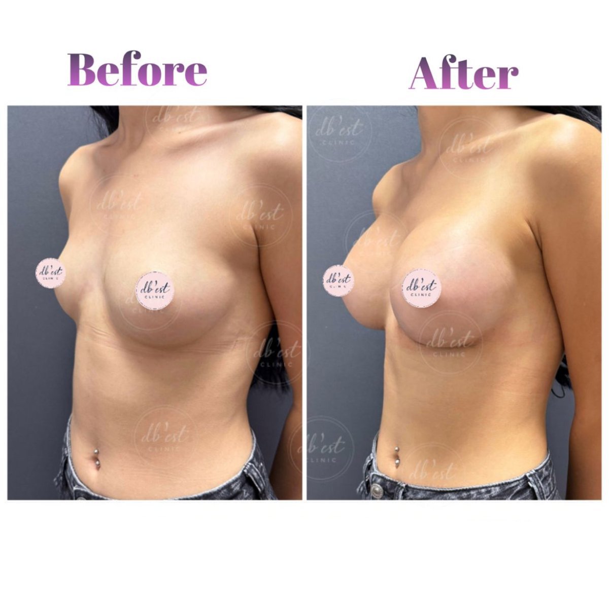 Before and after mammoplasty results at Db'est Clinic – enhanced breast shape and volume