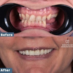 Zygomatic Implants by Straumann Official Provider for Severe Bone Loss Cases - photo 6