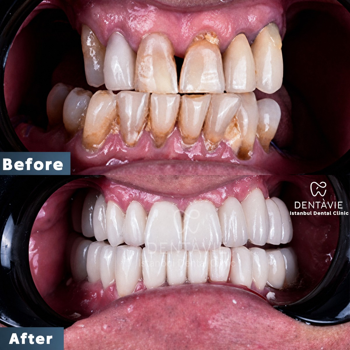 نتائج زراعة الأسنان قبل وبعد في Dentavie Istanbul Dental Clinic، ابتسامة محسنة