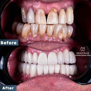Zygomatic Implants by Straumann Official Provider for Severe Bone Loss Cases - photo 4