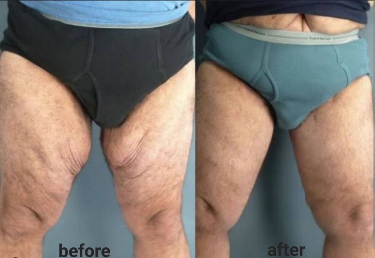 Before and after Morpheus8 skin tightening results on thighs at ID Clinic Bangkok