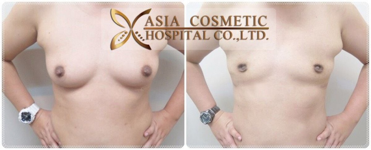 Before and after FTM top surgery results at Asia Cosmetic Hospital, chest masculinization