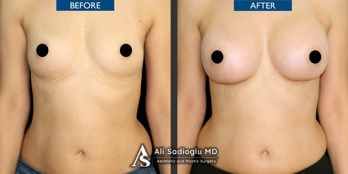 Before and after breast implants with lift results at Dr. Safa Manav Clinic, enhanced contour