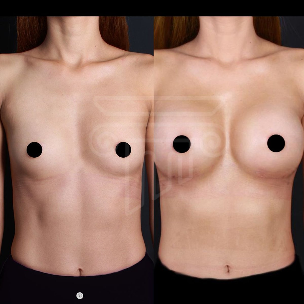 Resultados antes y después de implantes y lifting de senos en Dr. Safa Manav Clinic, mejor contorno