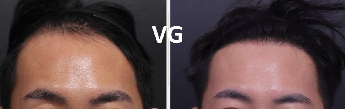 نتائج علاج تساقط الشعر بالبلازما PRP قبل وبعد في VG Plastic Surgery، كثافة شعر محسنة