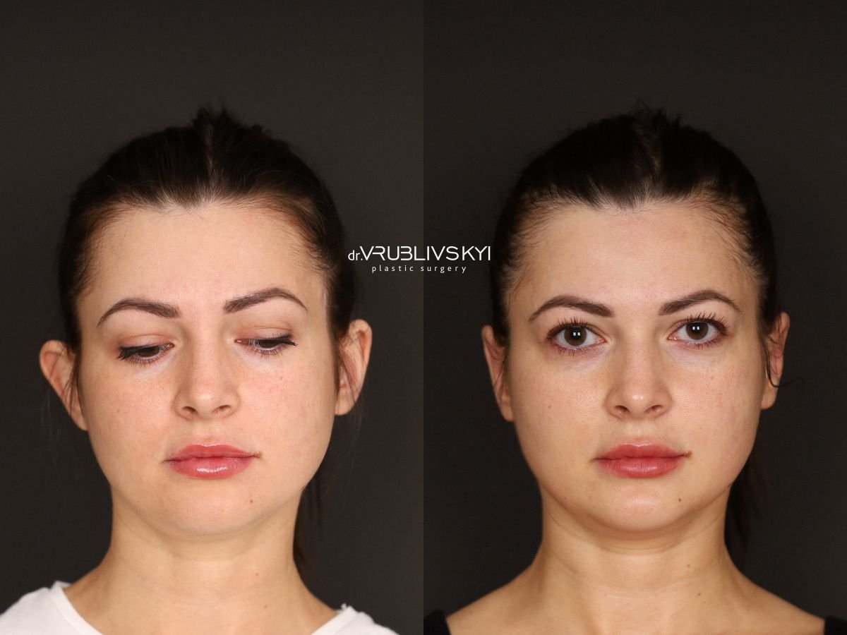 Результати отопластики до і після в Dr. VRUBLIVSKYI Plastic Surgery, корекція вух