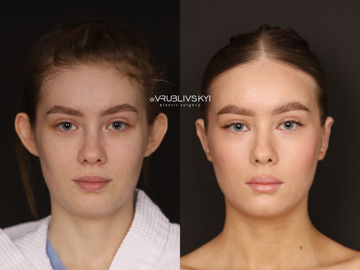 Before and after otoplasty results at Dr. VRUBLIVSKYI Plastic Surgery, ear reshaping outcome