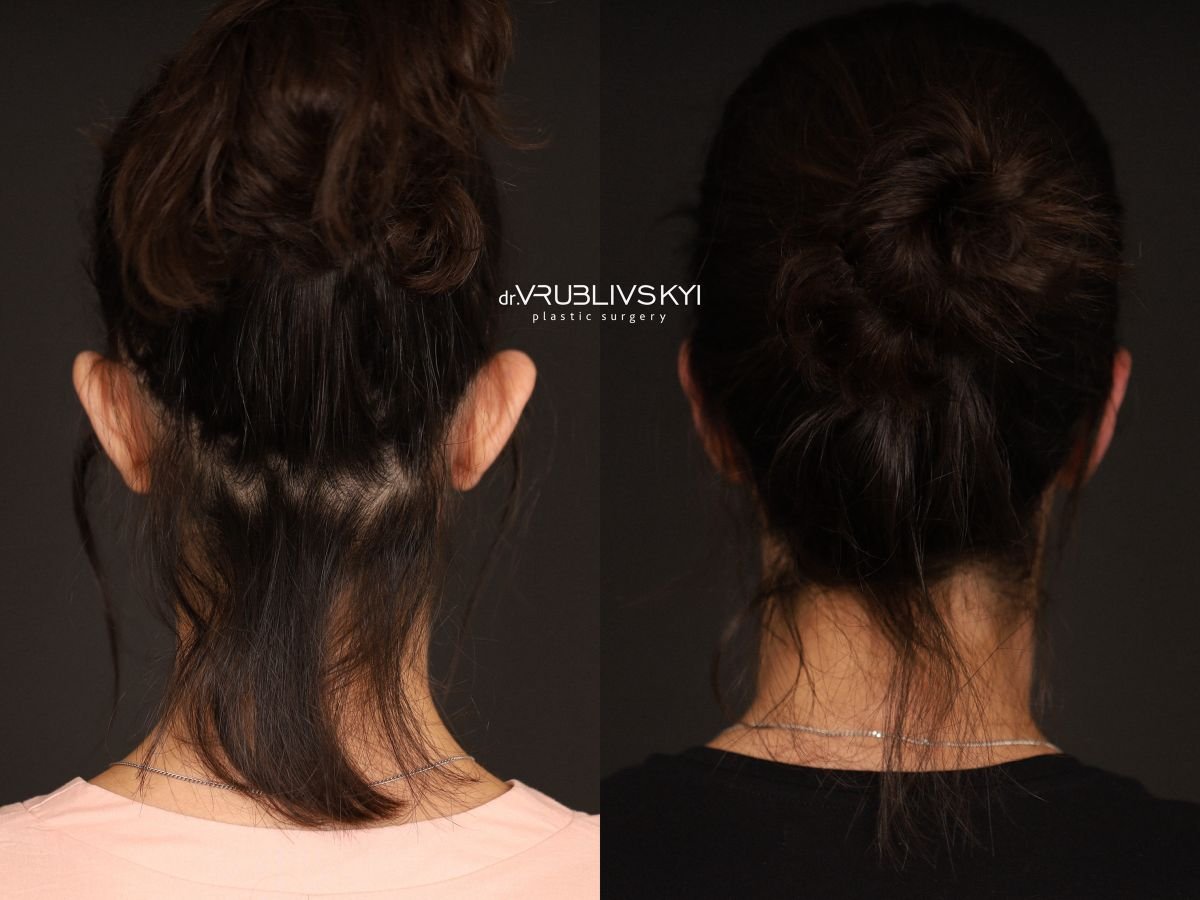 Resultados de otoplastia antes y después en Dr. VRUBLIVSKYI Plastic Surgery, corrección de orejas
