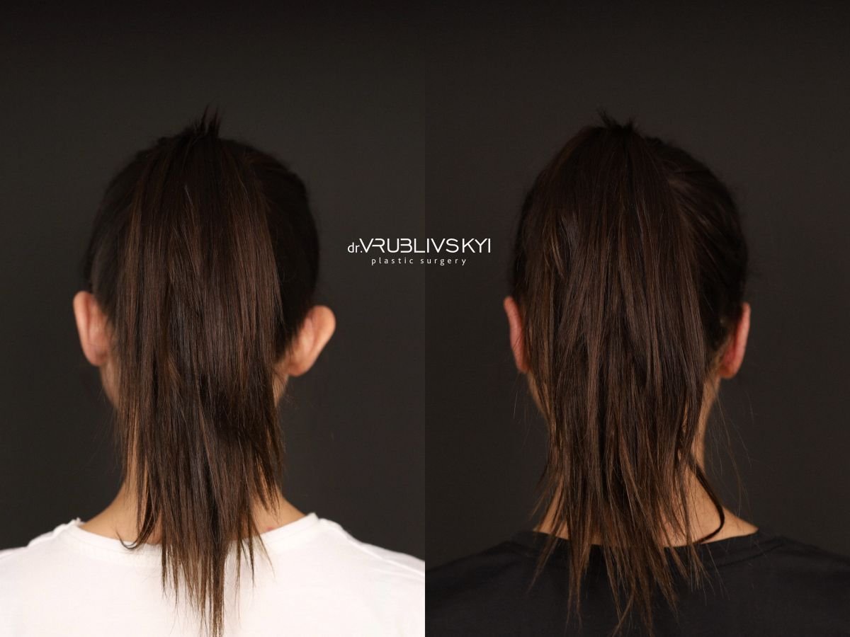 Resultados de otoplastia antes y después en Dr. VRUBLIVSKYI Plastic Surgery, corrección de orejas