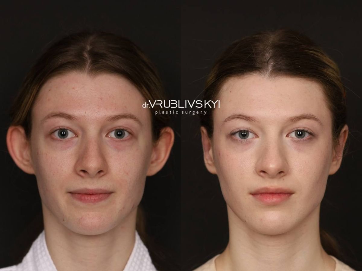 Otoplastik Vorher-Nachher-Ergebnis bei Dr. VRUBLIVSKYI Plastic Surgery, Ohrenkorrektur