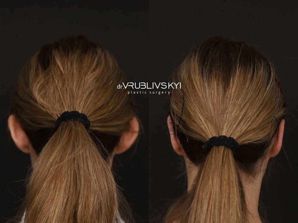 Результати отопластики до і після в Dr. VRUBLIVSKYI Plastic Surgery, корекція вух