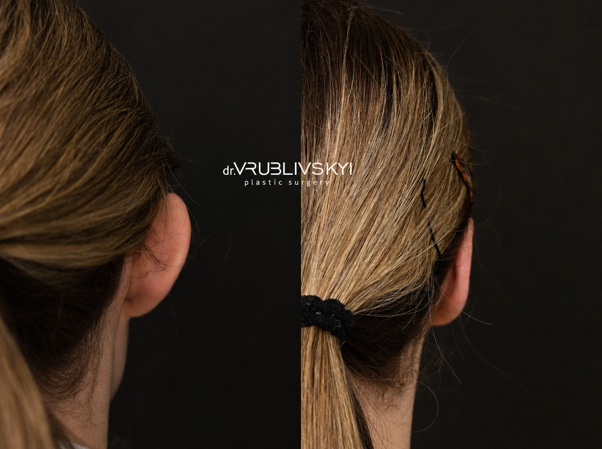 نتائج عملية تجميل الأذن قبل وبعد في Dr. VRUBLIVSKYI Plastic Surgery، تصحيح الأذن