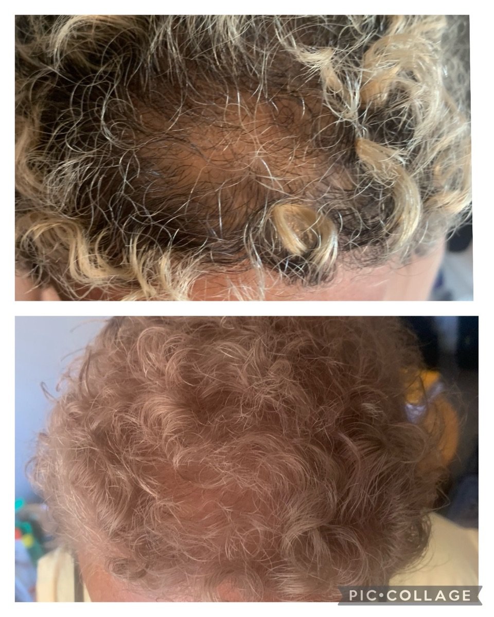 Avant et après thérapie de rajeunissement par cellules souches chez Juventa Regenerative Medicine, repousse des cheveux