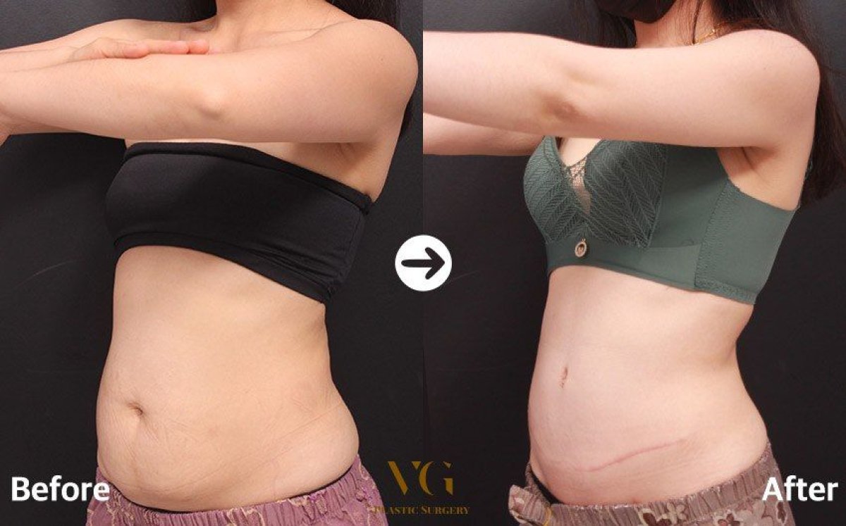 Mommy makeover before and after results at VG Plastic Surgery – visible abdominal contour improvement