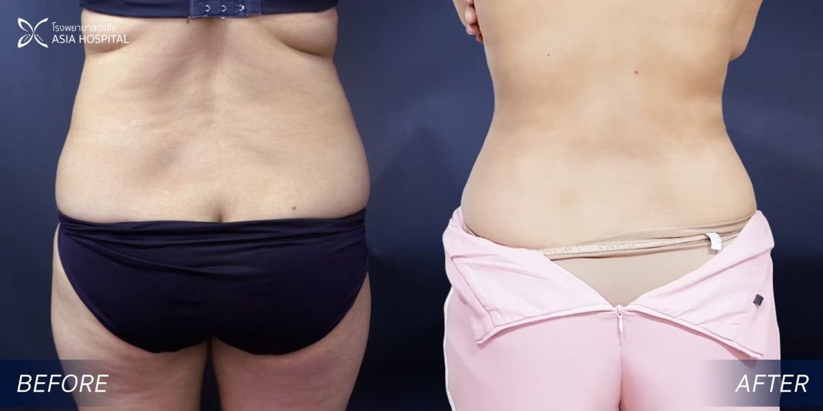 Before and after Vaser liposuction results at Asia Cosmetic Hospital, improved waist contour