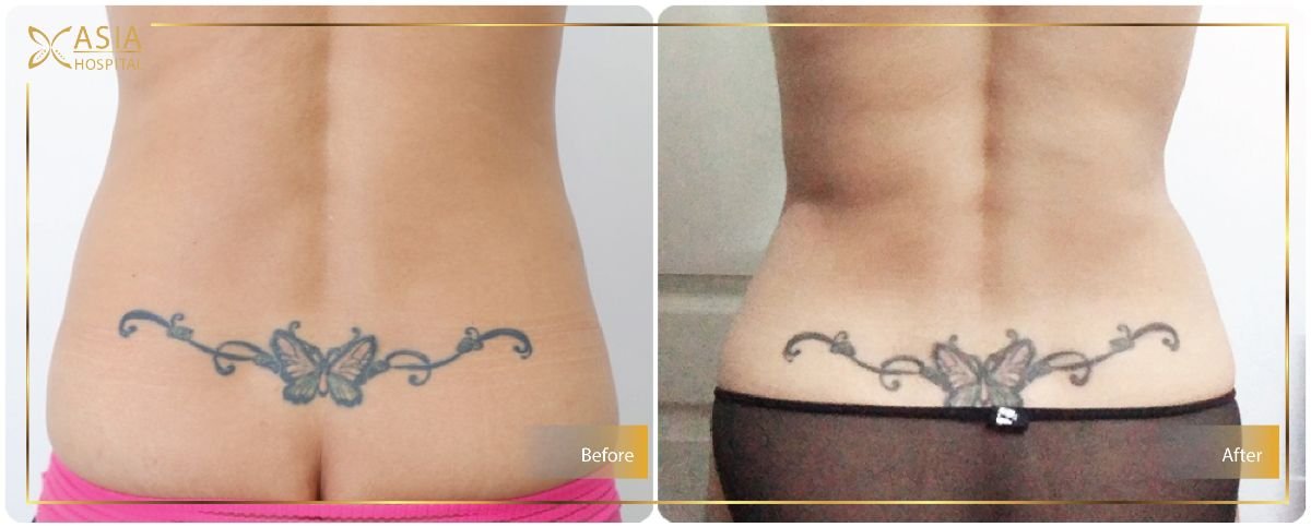 Before and after Vaser liposuction results at Asia Cosmetic Hospital, lower back contouring