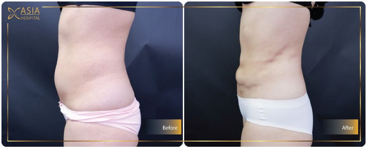 Before and after Vaser liposuction results at Asia Cosmetic Hospital, abdomen contour improved