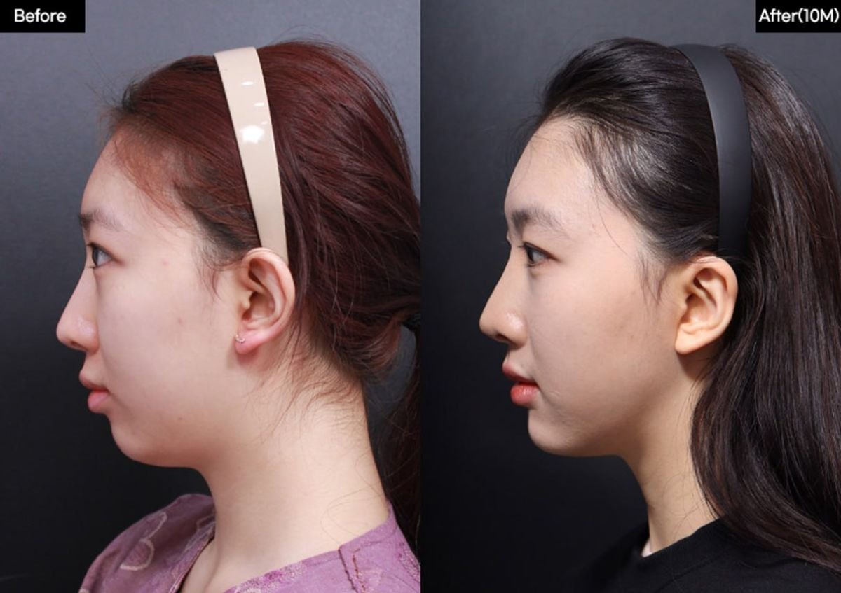 До и после имплантации подбородка в VG Plastic Surgery, улучшенный контур подбородка