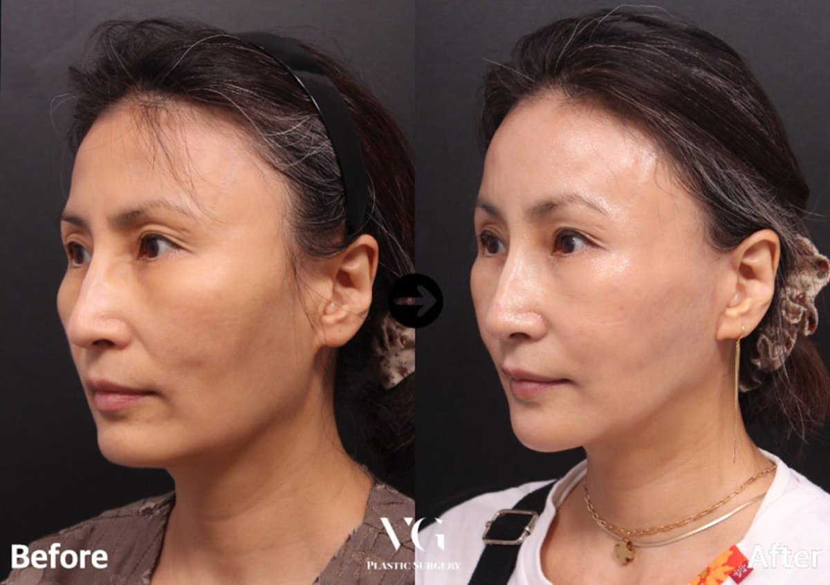 نتائج قبل وبعد زراعة الذقن في VG Plastic Surgery – تحسين تحديد الذقن