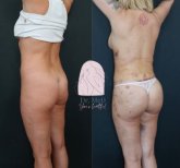 Before and after رفع المؤخرة البرازيلية photos by Dr. Muhammet Mustafa Aydinol