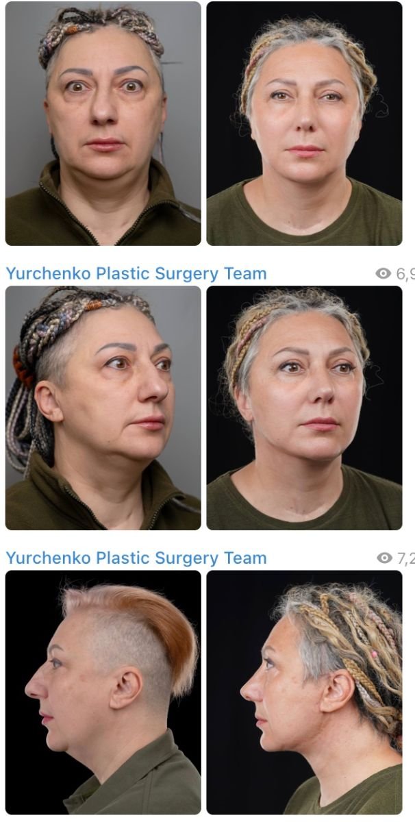 Результати до і після deep plane SMAS підтяжки у Yurchenko Plastic Surgery Team, омолодження обличчя
