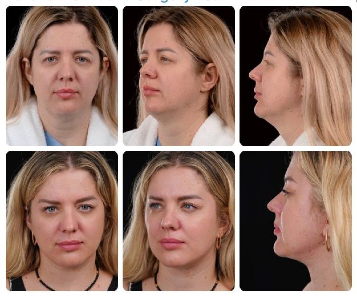 Результаты до и после deep plane SMAS лифтинга в Yurchenko Plastic Surgery Team, омоложение лица