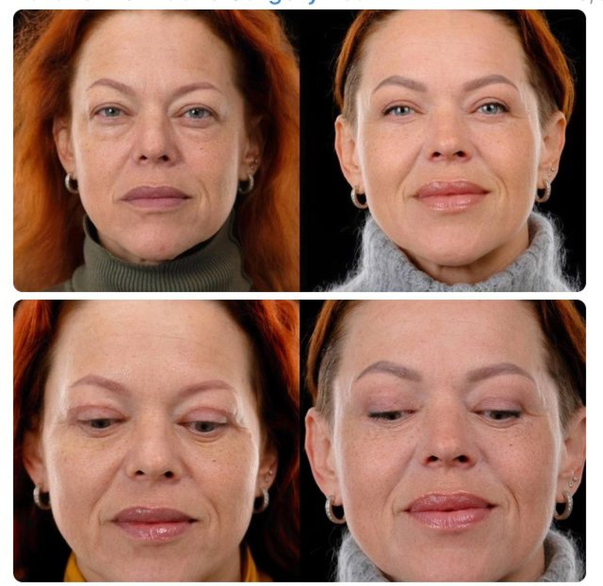 Before and after deep plane facelift results at Yurchenko Plastic Surgery Team, facial rejuvenation