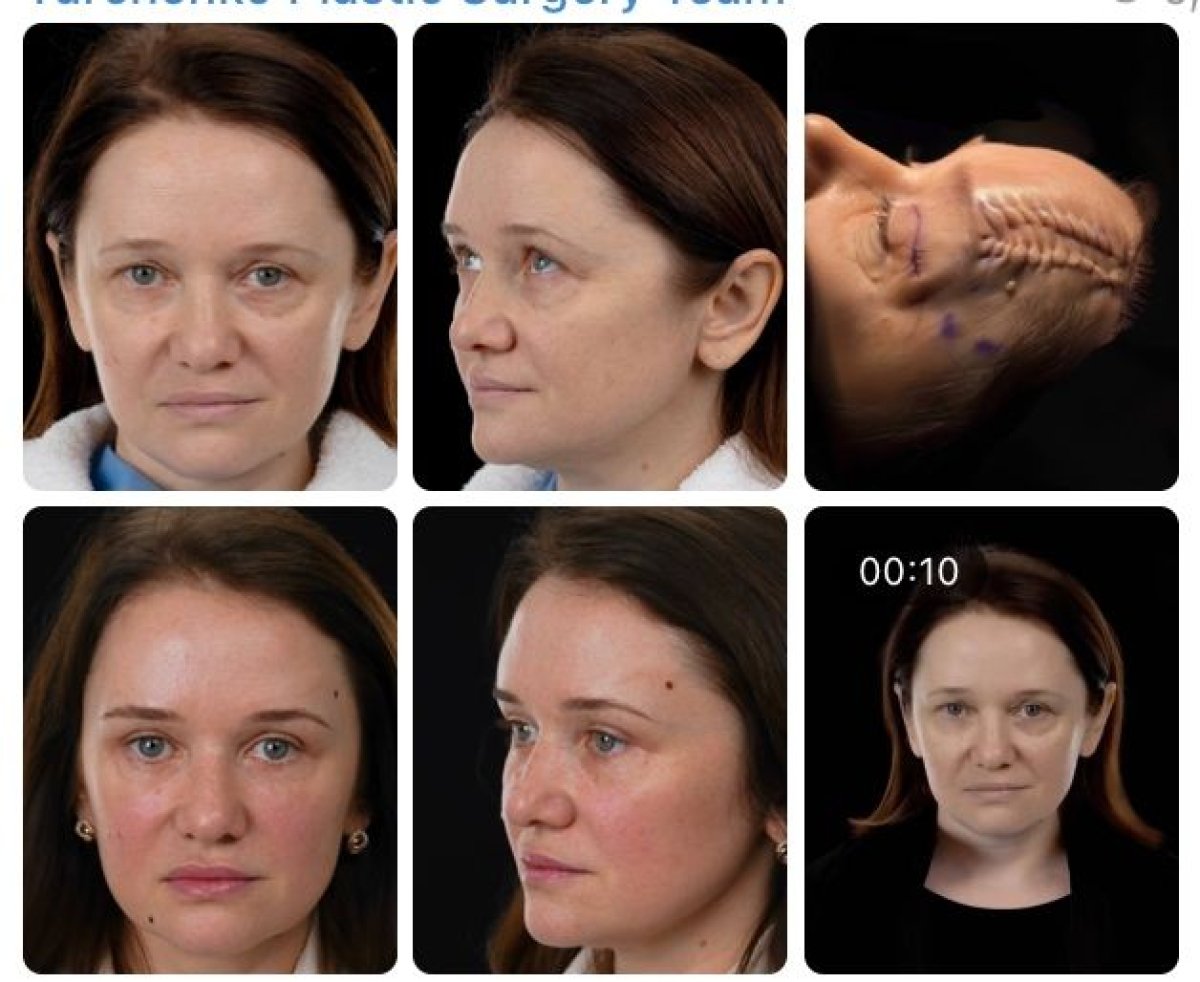 Результаты до и после deep plane SMAS-лифтинга в Yurchenko Plastic Surgery Team, омоложение лица