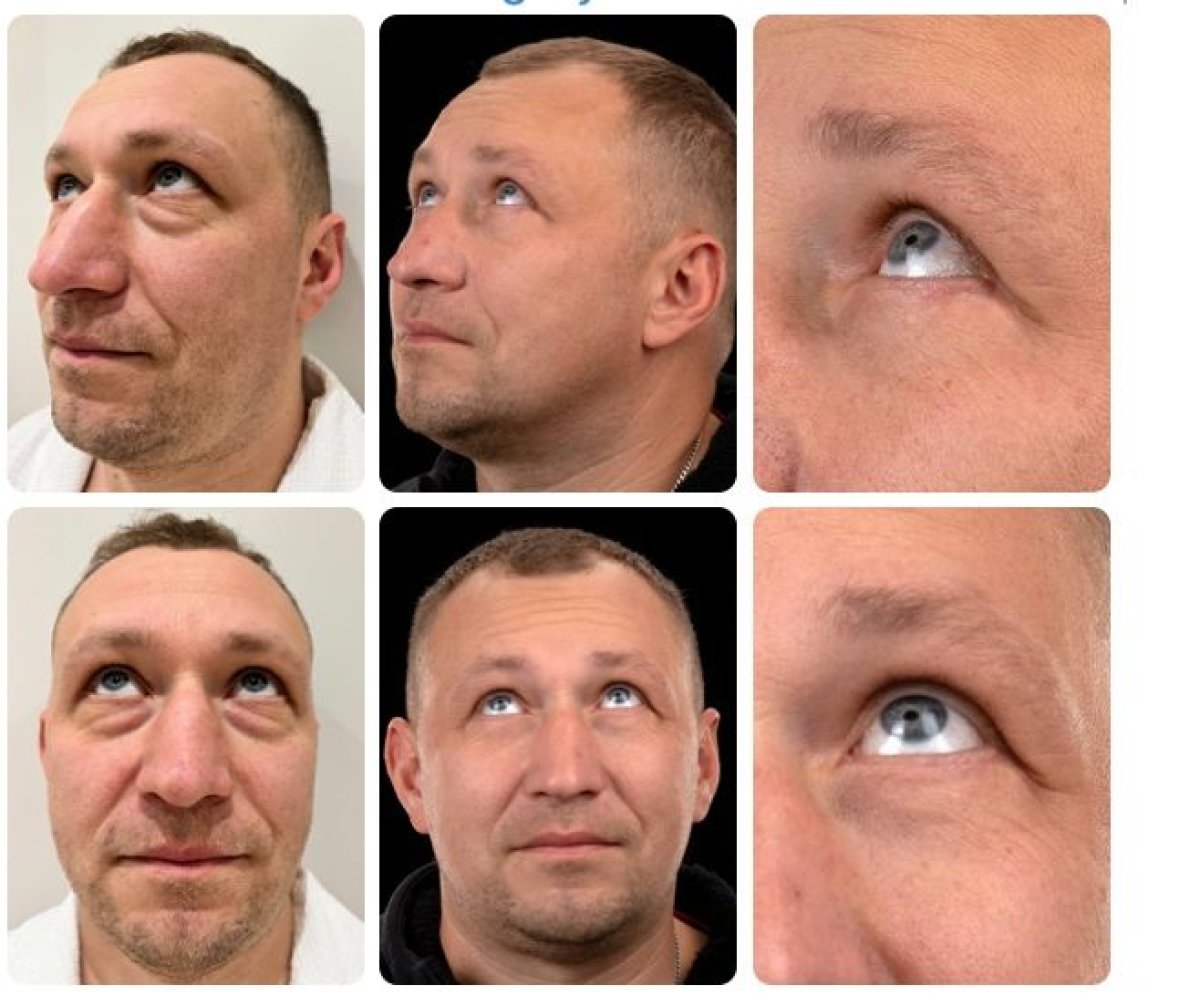 نتائج شد الوجه العميق قبل وبعد في Yurchenko Plastic Surgery Team، تجديد شباب الوجه