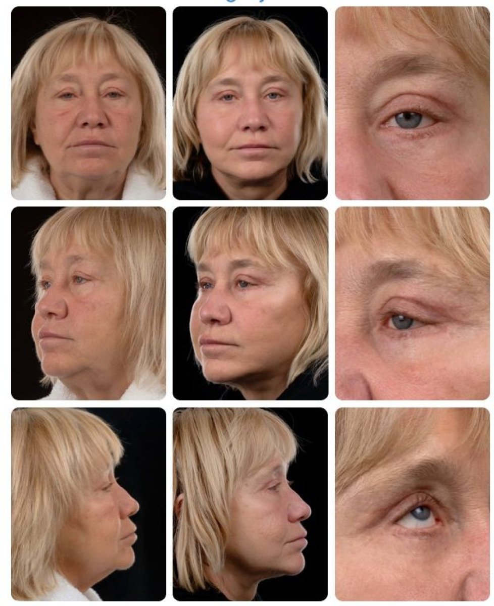 Résultats avant/après lifting deep plane chez Yurchenko Plastic Surgery Team, rajeunissement du visage