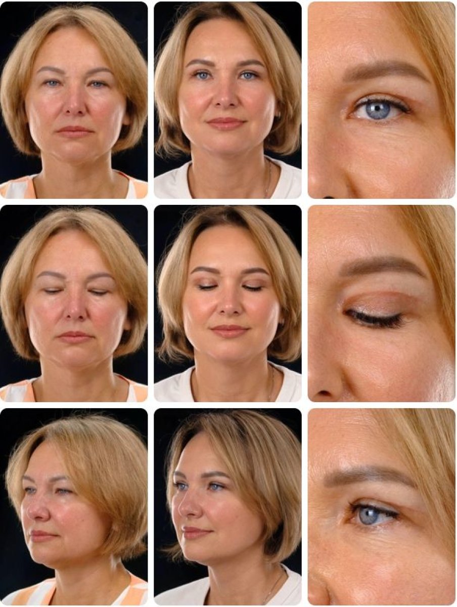 Before and after deep plane facelift results at Yurchenko Plastic Surgery Team, facial rejuvenation