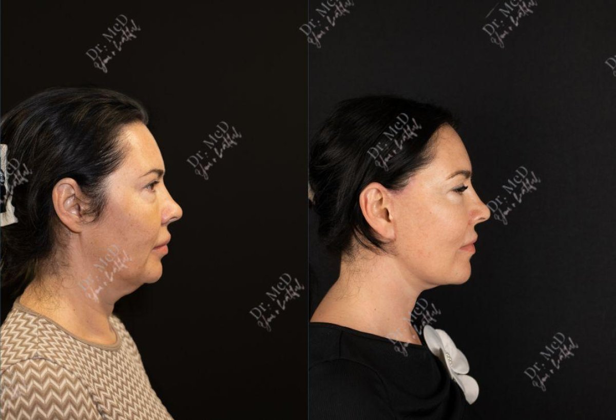 Facelift before and after results at Dr. MED – visible jawline and neck contour improvement