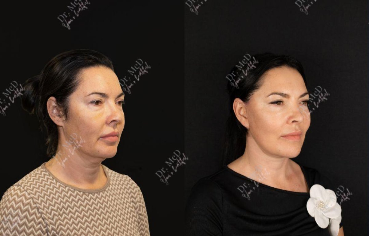 Resultados de lifting facial antes y después en Dr. MED, rejuvenecimiento y mejora del contorno