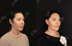Before and after Facelift photos by Dr. Ugur Horoz