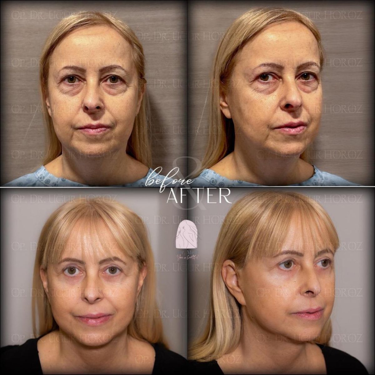 Resultados de lifting facial antes y después en Dr. MED – rejuvenecimiento visible