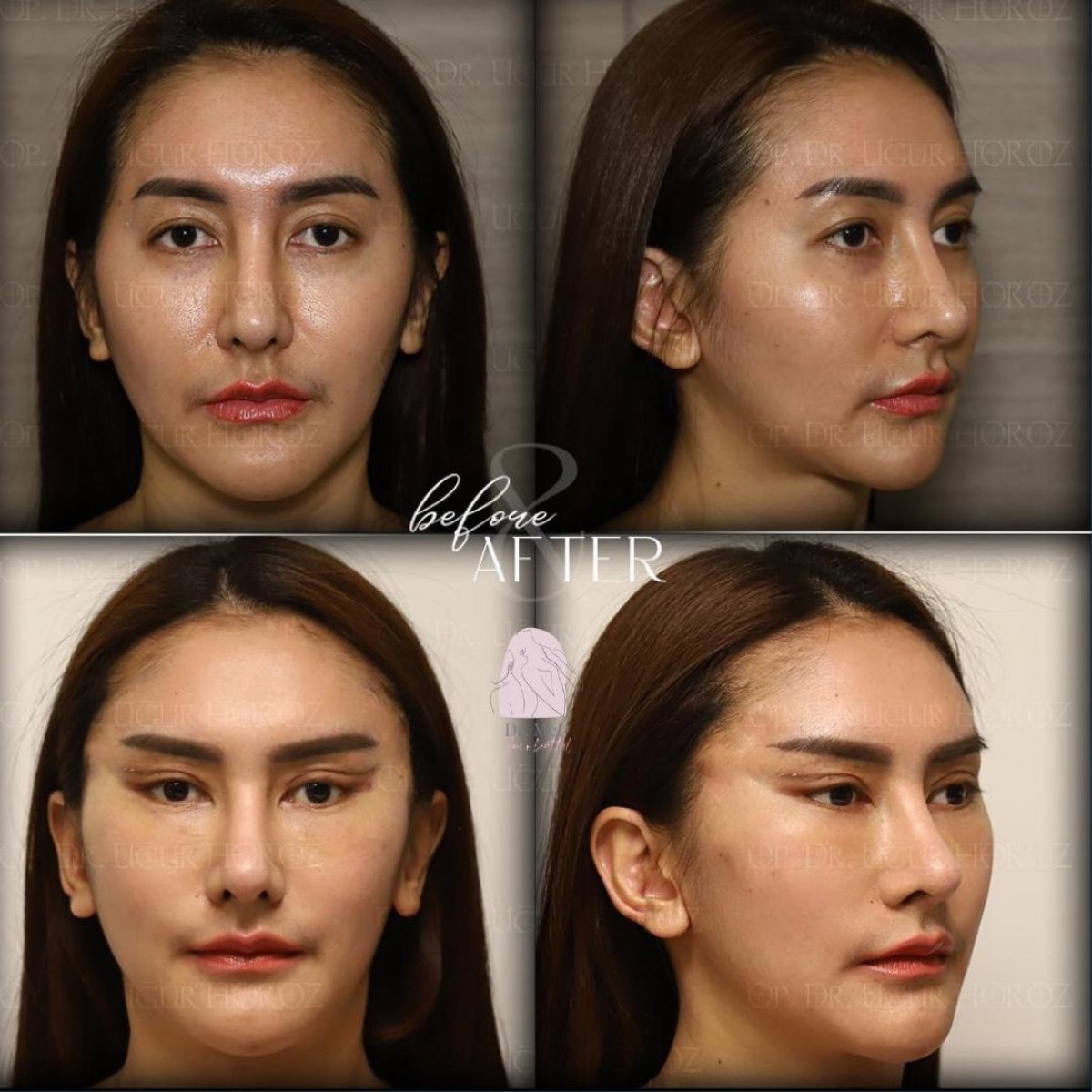 Before and after brow lift results at Dr. MED – lifted brow and rejuvenated eye area