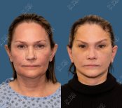 Before and after Facelift photos by Dr. Ugur Horoz