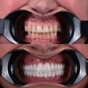 All-on-4 Implants with 24 Zirconia Crowns by Straumann Official Provider - photo 4