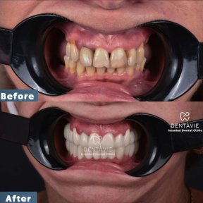 All-on-4 Implants with 24 Zirconia Crowns by Straumann Official Provider - photo 6