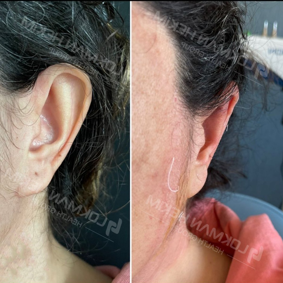 نتائج عملية تجميل الأذن قبل وبعد في مستشفى لوكمان حكيم إسطنبول، تصحيح الأذن